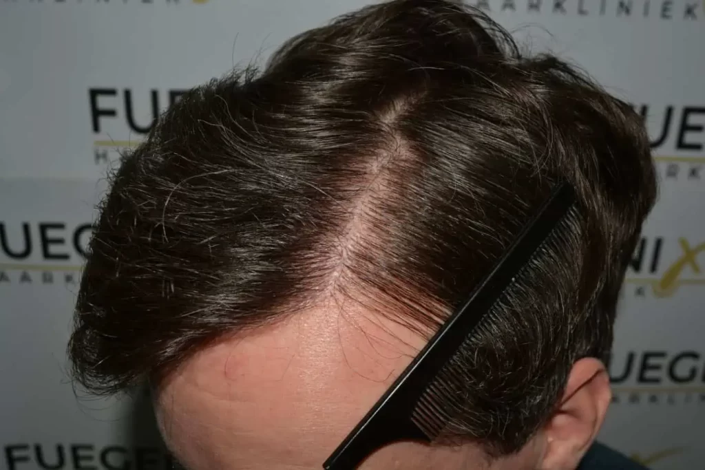 The Henry Cavill Hairline