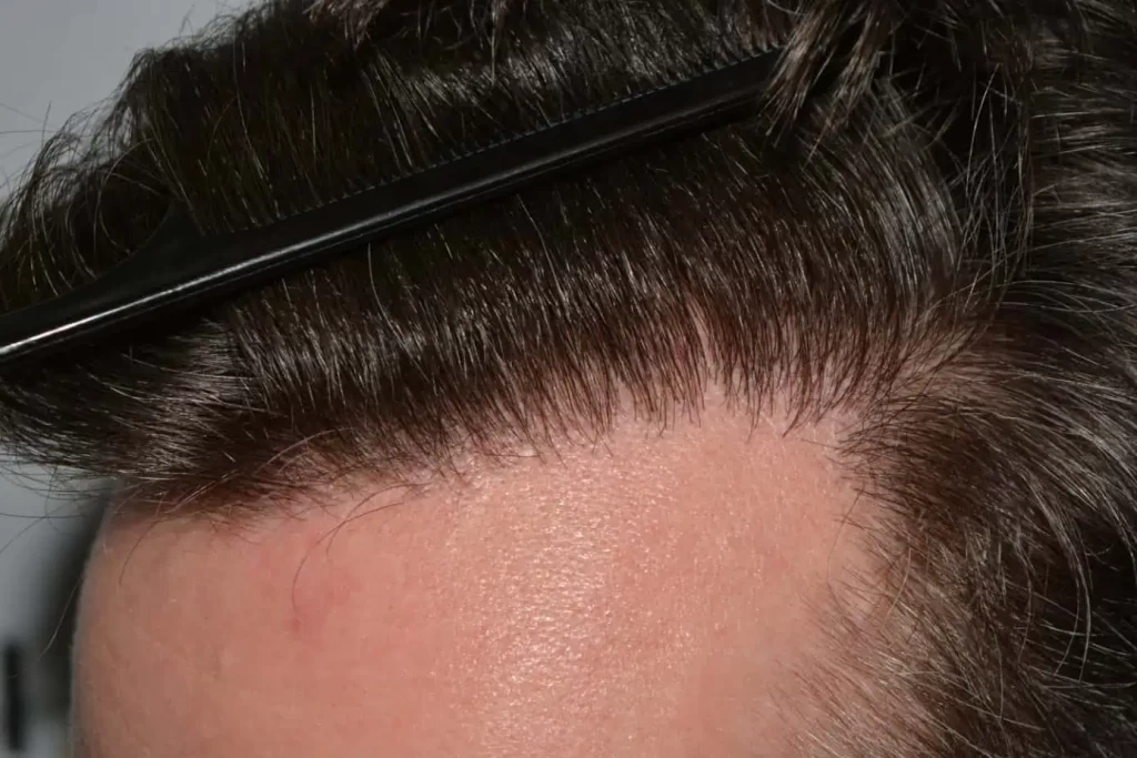 The Henry Cavill Hairline