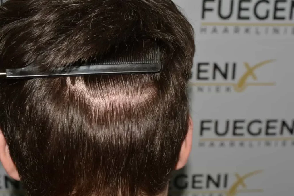 The Henry Cavill Hairline