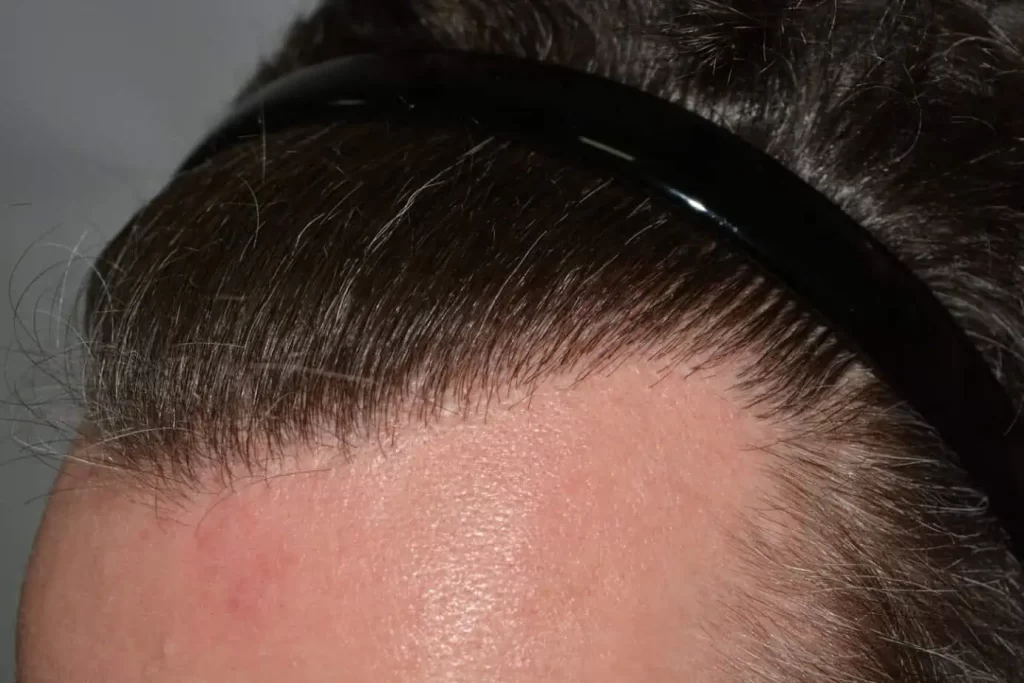 The Henry Cavill Hairline