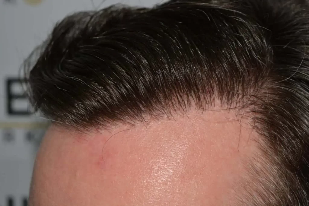 The Henry Cavill Hairline