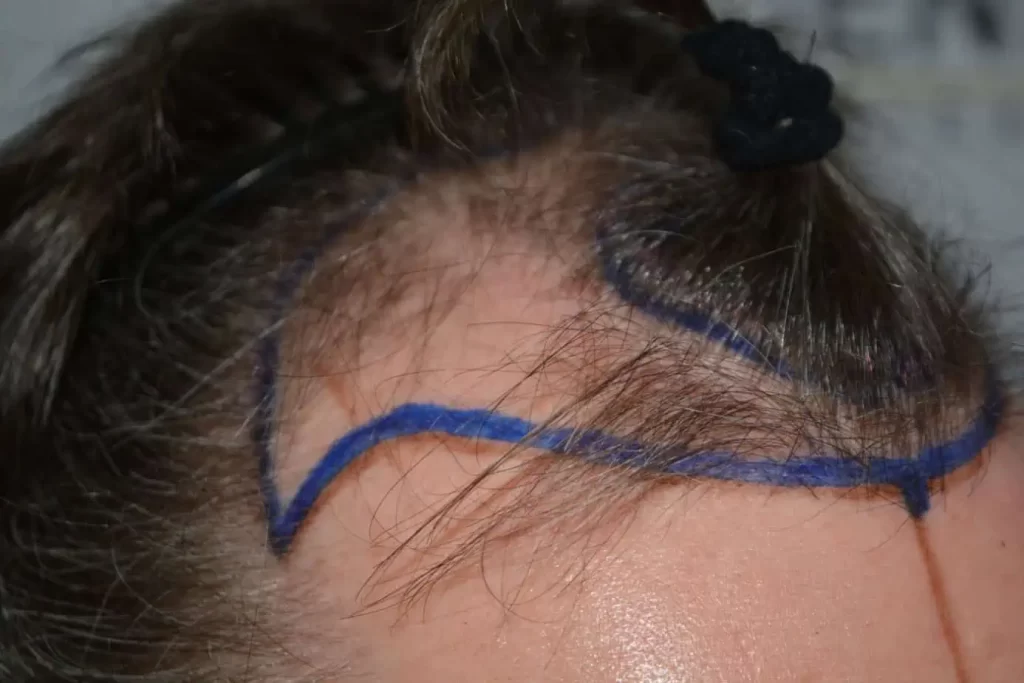 The Henry Cavill Hairline